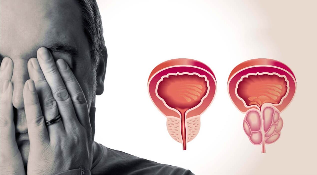 Próstata saudável e dolorida em homens
