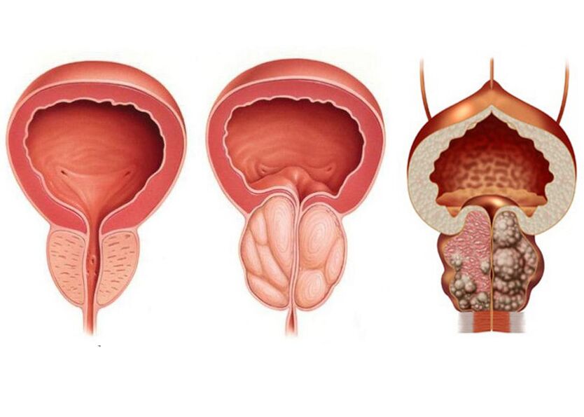 estágios da prostatite e a necessidade de usar completamente o prostavit